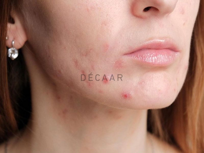 mụn trứng cá bọc